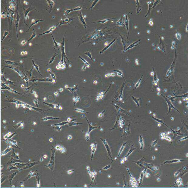 淀粉样变是一种罕见的疾病，其特征是体内异常淀粉样沉积物的堆积