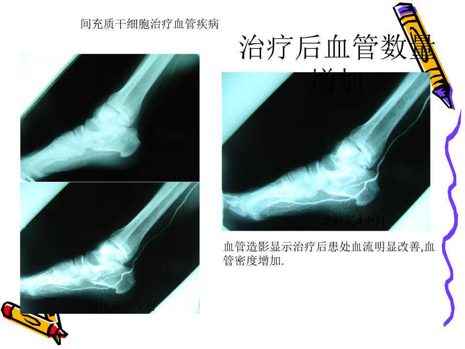 芯片技术辅助干细胞治疗眼疾