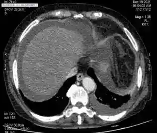 服用自种“三七”来养生，八旬老太吃出肝窦阻塞综合征